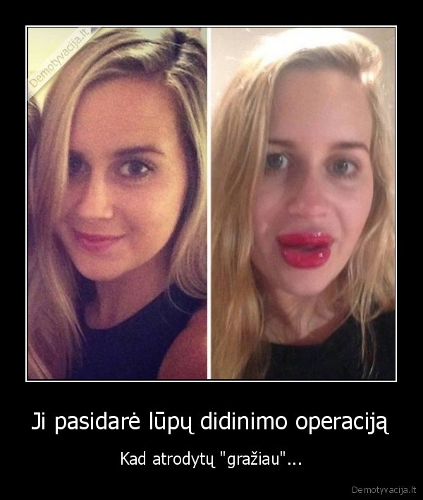 Ji pasidarė lūpų didinimo operaciją - Kad atrodytų 