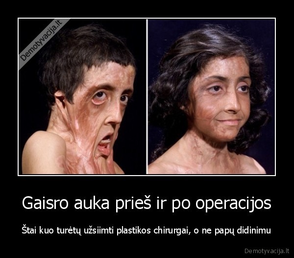 Gaisro auka prieš ir po operacijos - Štai kuo turėtų užsiimti plastikos chirurgai, o ne papų didinimu. 
