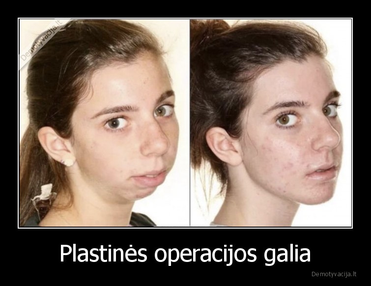 Plastinės operacijos galia. 